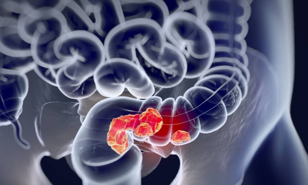 Irlanda alavanca IA para tornar rastreio do cancro do intestino mais preciso